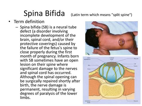 spina bifida definition medical
